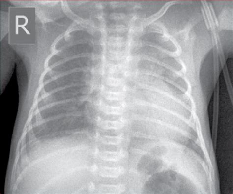 Check out our new ground glass appearance on cxr study sets and optimise your study time. Ground-glass appearance on chest X-ray of a patient with ...