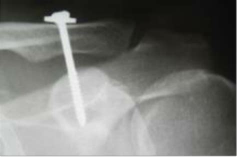 Acromioclavicular Joint Dislocations Treated With Coracoclavicular