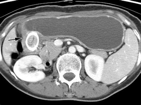 Ct And Pet In Stomach Cancer Preoperative Staging And Monitoring Of