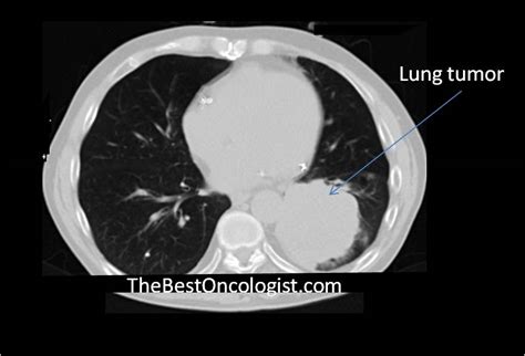 Can Lung Cancer Be Diagnosed With A Ct Scan Ct Scan Machine