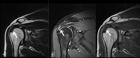 On t1 images fat is white. MRI coronal T2 (a), PD with fat suppression (b) and T1 (c ...