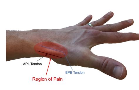 De Quervain Tendonitis Raleigh Hand Surgery — Joseph J Schreiber Md