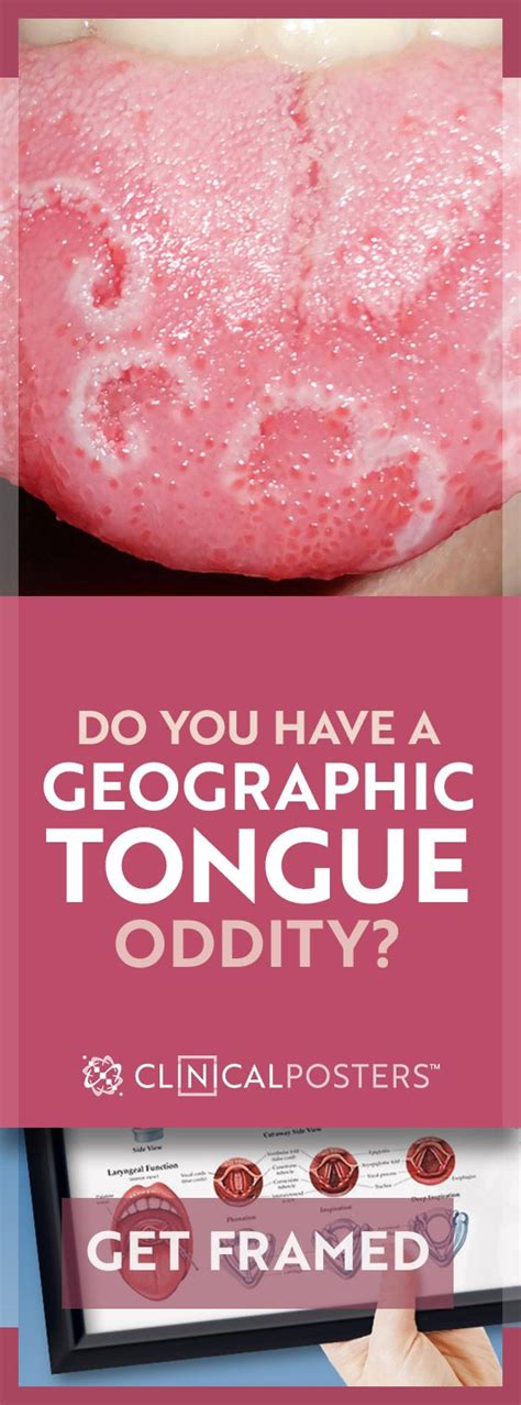 Pardon My Geographic Tongue Geographic Tongue Tongue Tongue Cleaner