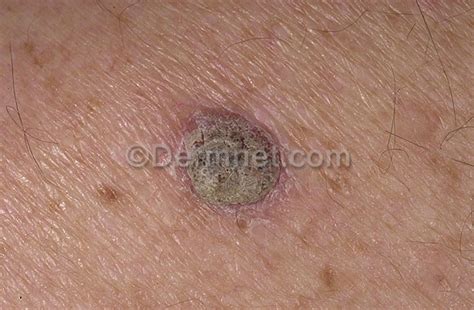 Pictures Of Keratosis Dorothee Padraig South West Skin Health Care