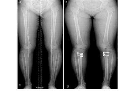 A Preoperative Full Length Standing Radiograph Showing Genu Varum