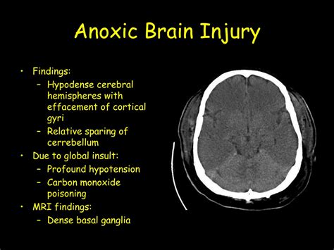 Ppt Anoxic Brain Injury Powerpoint Presentation Free Download Id