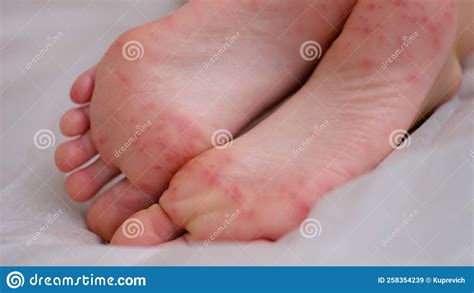 Pijnlijke Rode Vlekken Op De Huid Stock Afbeelding Image Of Ziek