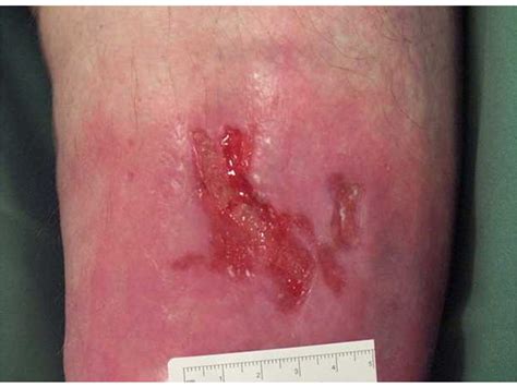 To prevent infection and reduce scarring, don't pick at the scab or skin around the wound. Promoting Healthy Skin - 7. Wound Care - A. Wound Healing