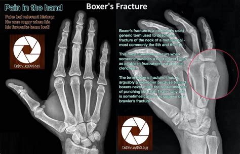 Boxer S Fracture Hand X Ray Diagnosis Fracture Of Grepmed