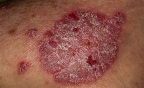 Prevalence Of Hidradenitis Suppurativa Increased In Patients With