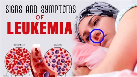 Signs And Symptoms Of Leukemia Youtube