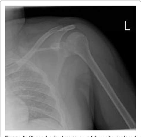 Figure From Isolated Avulsion Fracture Lesser Tuberosity Of The