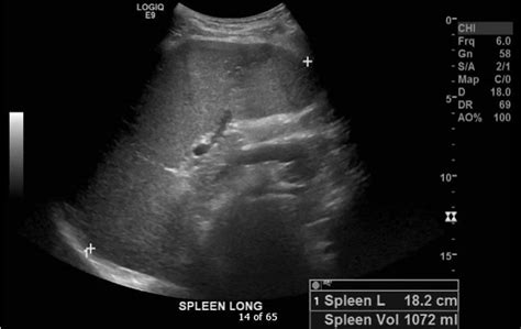 Cureus Incidental Diagnosis Of Adult Beta Thalassemia With Point Of