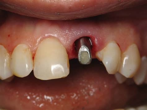 Immediate Front Tooth Dental Implant Example Difficult Case
