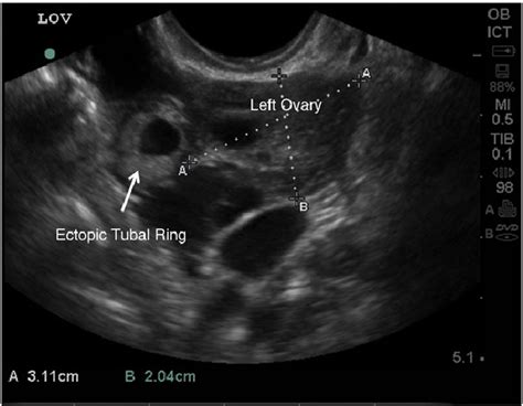 Ectopic Pregnancy With Thickened Tubal Ring Download Scientific Diagram