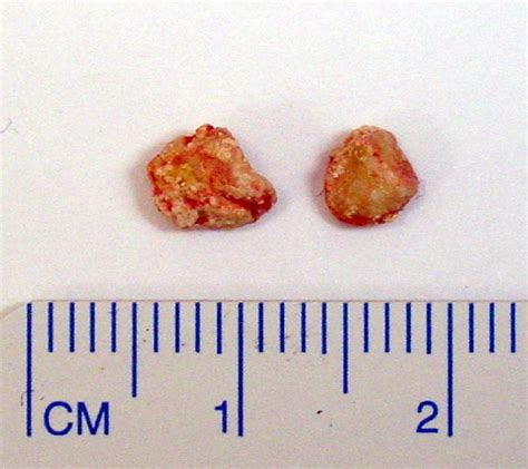 Salivary Gland Stones After Removal From Submaxillary Gland Duct