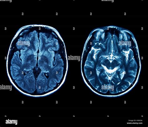 Mri Scan Of Brain Hi Res Stock Photography And Images Alamy