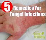 Home Remedies Fungal Rash Pictures