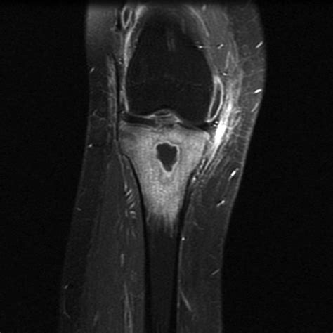 Osteomyelitis Proximal Tibia Image