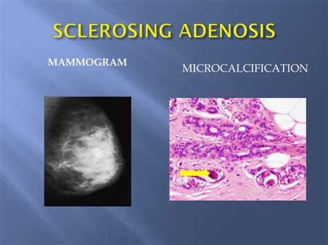Ppt Microcalcification In Benign Breast Disease Powerpoint