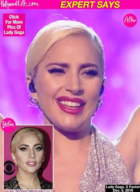 Lady Gaga Did She Have Work Done On Her Face Plastic Surgeon Speaks