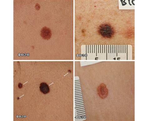 What Do Early Stages Of Skin Cancer Look Like Valley Vrogue Co