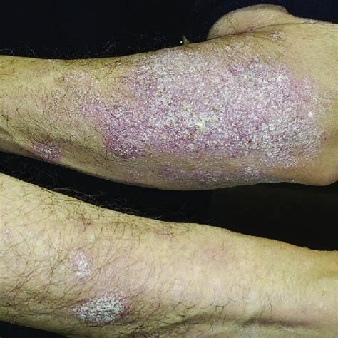 Pdf Dupilumab Induced Phenotype Switching From Atopic Dermatitis To