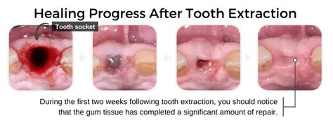 Tooth Extraction Aftercare Instructions The Dos And Donts