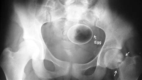 X Rays From Radiopaedia Show Objects In Strange Places