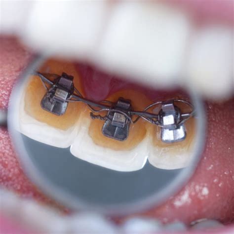Orthodontics Mint Dental Dc