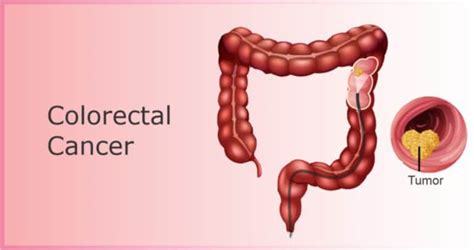 What Is Colorectal Cancer Causes Symptoms Treatment