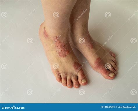 Closeup Of The Legs Of A Woman Suffering From Chronic Psoriasis On A