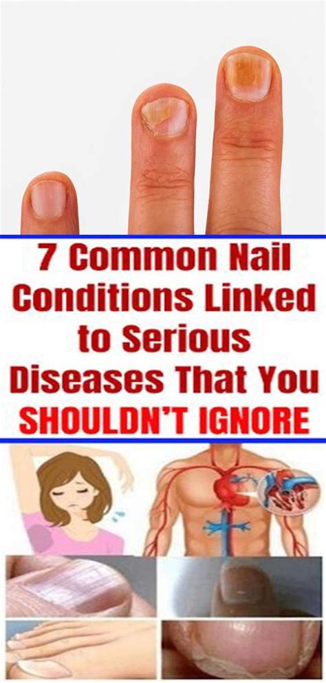 You Shouldnt Ignore These 5 Warning Symptoms Your Nails Might Be