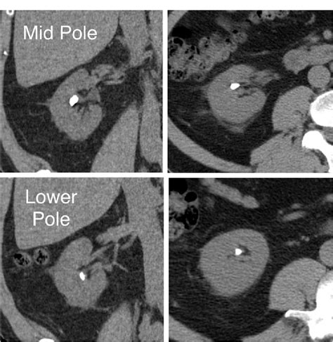 Figure 1 From Outpatient Tubeless Percutaneous Nephrolithotomy