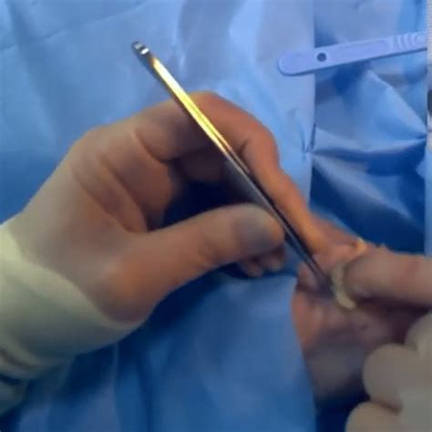 Removal Of Abscess Drainage Catheter Cpt Code