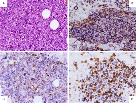 Appearance Of The Lymphoma Cells In The Bone Marrow Biopsy Specimen