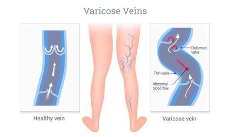Varicose Veins And Spider Veins How Are They Different