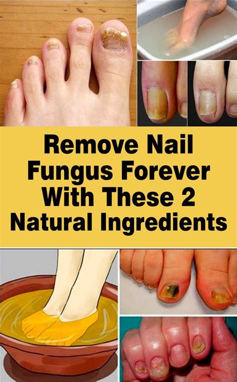 Get Rid Of Nail Fungus Forever 2 Ingredient Recipe