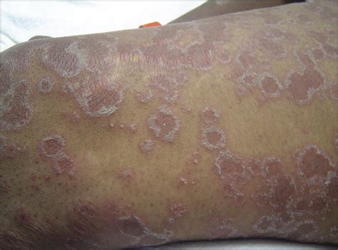 Acute Generalized Exanthematous Pustulosis Induced By Clindamycin