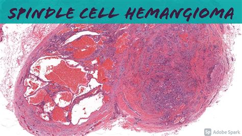Spindle Cell Hemangioma 101 Youtube
