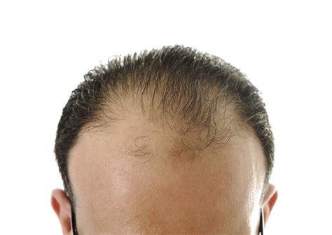 Why Is My Hair Thinning Signs Of Balding In Your S S