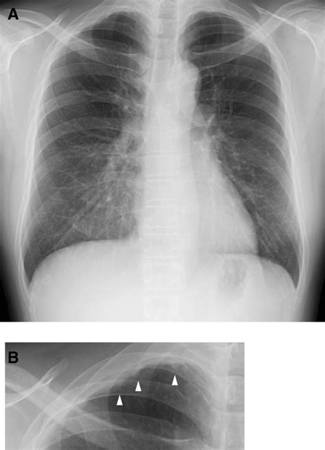 Representative Chest X Ray Image Of Pleural Thickening A Chest X Ray