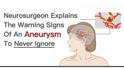 Brain Surgeon Explains The Warning Signs Of An Aneurysm To Never Ignore