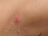 Armpit Pimple Treatment Images
