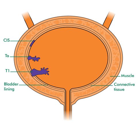 Sometimes when the first symptoms of bladder cancer appear, the cancer has already spread to another part of the body. Staging and grading non-invasive bladder cancer ...