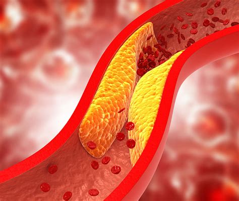 Peripheral Arterial Disease Northwest Endovascular Surgery