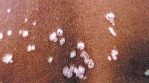 Lichen Sclerosus Symptoms Causes And Treatment