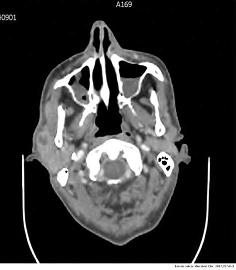 Cat Scratch Disease Presenting As Parotid Gland Abscess And Aseptic