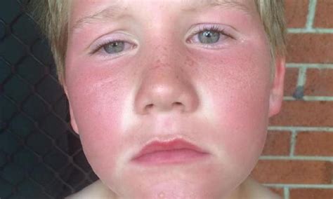 Boy 9 Suffers Second Degree Burns After Applying Sunscreen Kidspot