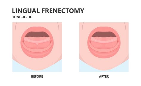 Does Your Child Need A Lingual Frenectomy Arctic Dental